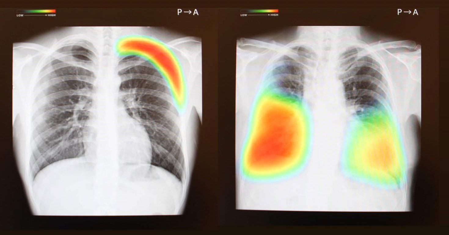 イメージ:胸部X線診断