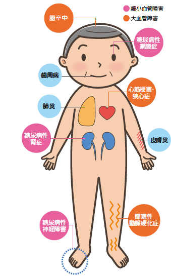 糖尿病